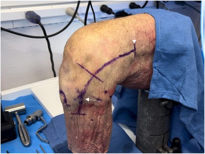 Lateral approach to the knee through an incision along the iliotibial band that curves distally towards Gerdy tubercle, between the fibular