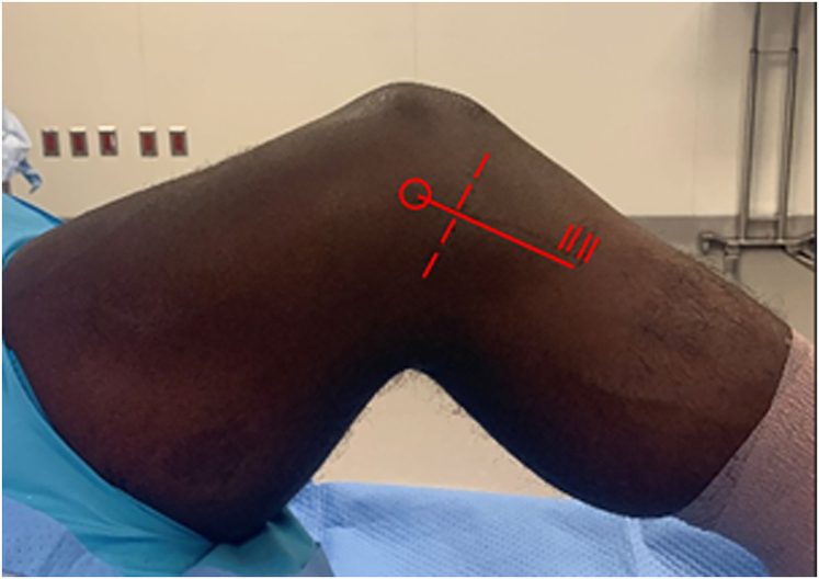 Medial knee landmarks, with the medial femoral epicondyle (circle), the joint line (dotted line) and the pes anserinus insertion (parallel l