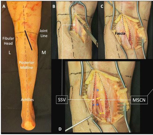Cadaveric posterior approach to the knee, with an oblique incision near the posterior midline and the fascia opened to show the small saphen