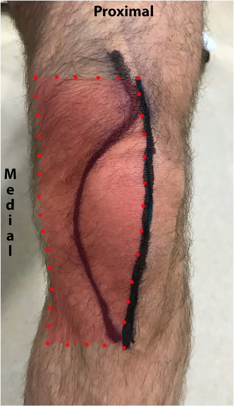 Midline skin incision and the line of the medial parapatellar arthrotomy drawn on a left knee, with the arthrotomy extending proximally into