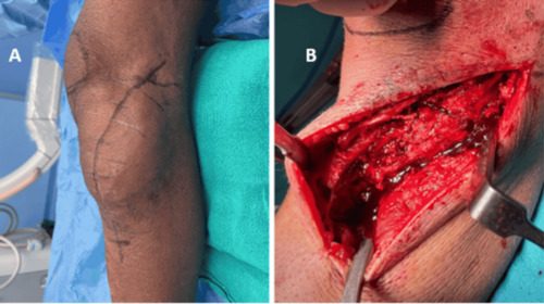 Anterolateral approach to the proximal tibia, showing the curved skin incision below the knee and the exposure of the lateral tibial metaphy