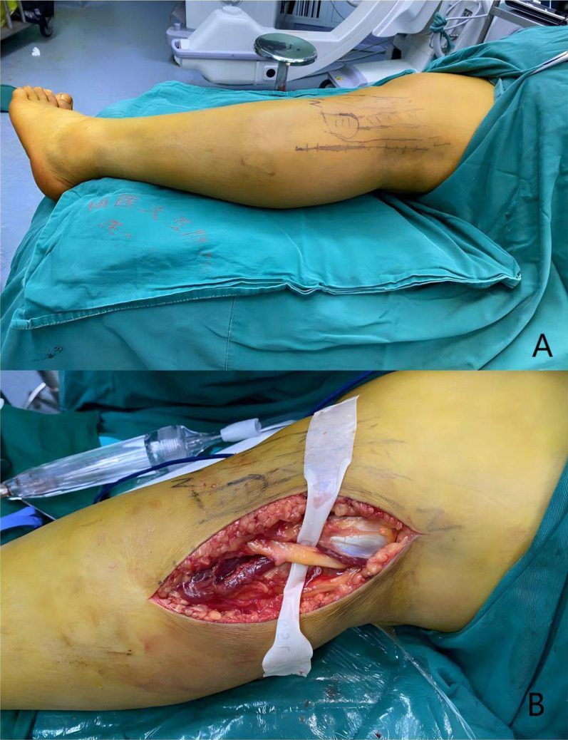 Posterolateral approach to the proximal tibia in the lateral decubitus position, with a straight incision along the posterior edge of the fi