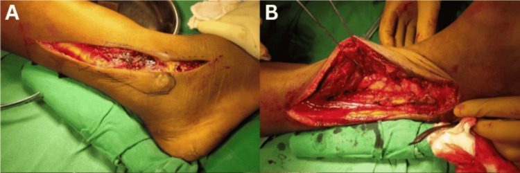 Incision along the anterior border of the fibula, with the peroneal muscles retracted posteriorly and the peroneus tertius and extensor digi
