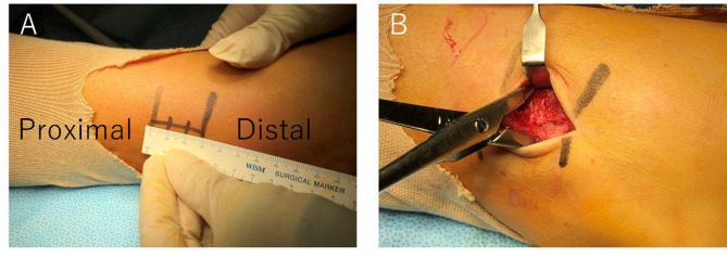 Short lateral incision over the distal fibula for a Weber B fracture, with the fracture exposed and held with a reduction clamp