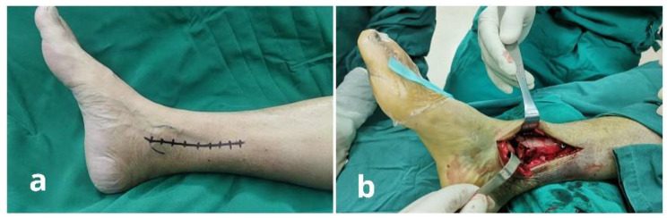 Medial incision centred over the medial malleolus, running from 1 cm below its tip to about 8 to 10 cm above the ankle joint, with the malle