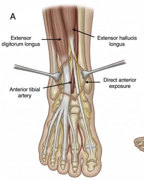 Anterior approach to the ankle joint through the interval between extensor hallucis longus and extensor digitorum longus, with the anterior