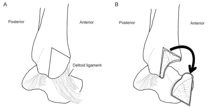 Chevron medial malleolar osteotomy with the deltoid ligament left attached, so that the malleolar fragment can be turned down distally to ex