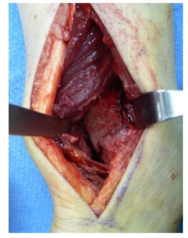 Posterolateral approach to the ankle, with the posterior malleolar fragment seen in the interval between the peroneal tendons and flexor hal