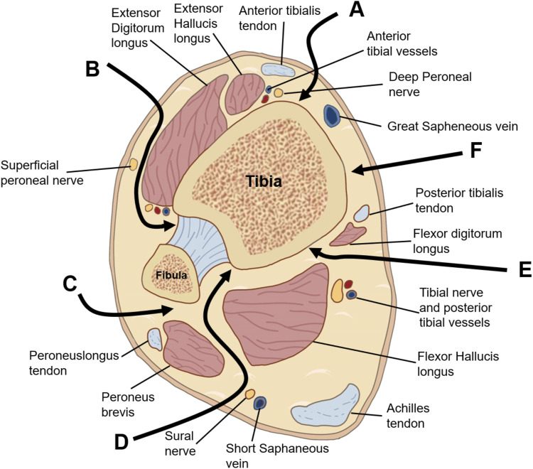 Cross section of the distal leg showing the intervals used to reach the distal tibia, including the posteromedial corridor between the poste