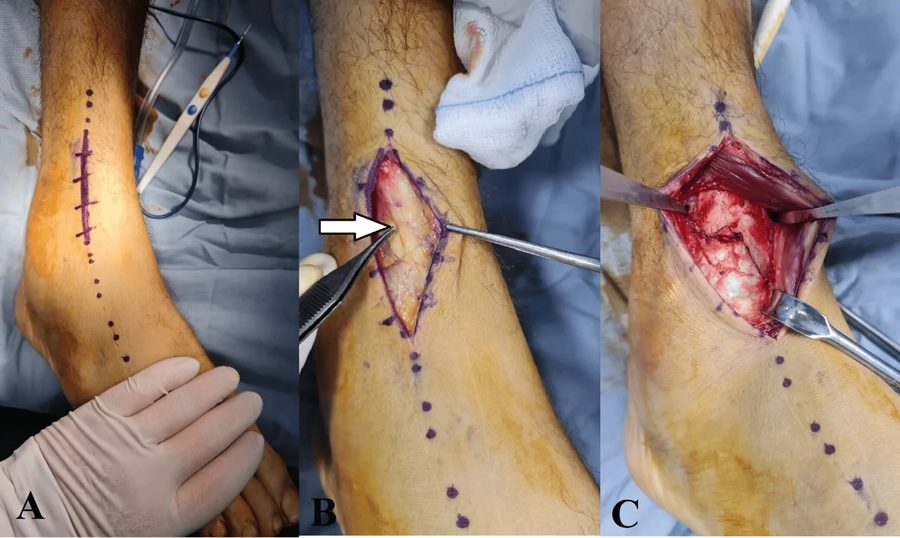 Anterolateral approach to the ankle through a slightly curved incision between the tibia and fibula, with the superficial peroneal nerve ide