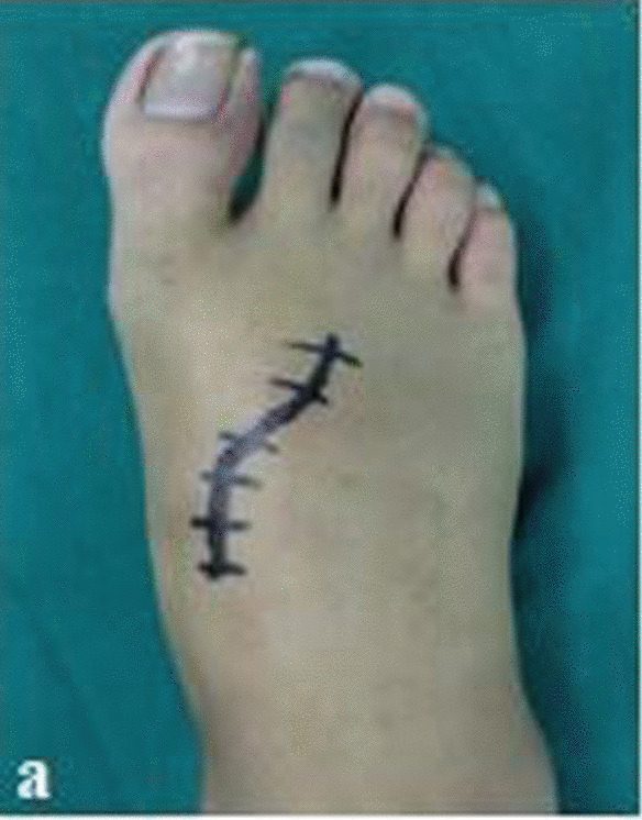 Curved dorsal incision marked between the first and second metatarsals over the tarsometatarsal joints for open treatment of a Lisfranc inju