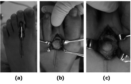 Dorsal longitudinal incision placed directly over the second metatarsophalangeal joint, with the capsule opened to expose the metatarsal hea