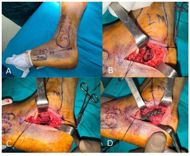 Sinus tarsi approach to the calcaneus, showing the skin marking below the lateral malleolus, exposure of the fracture and reduction and plat