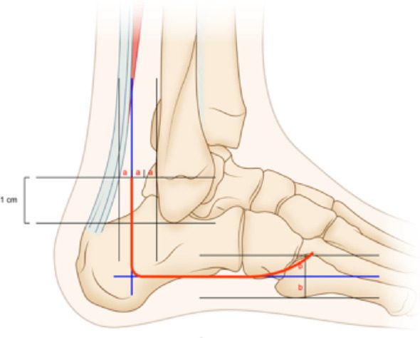 Diagram of the extensile lateral L shaped incision of the calcaneus, with a vertical limb anterior to the Achilles tendon and a horizontal l