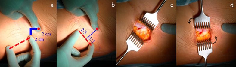 Marking the bikini incision for the direct anterior approach, starting 2 cm distal and lateral to the anterior superior iliac spine and runn