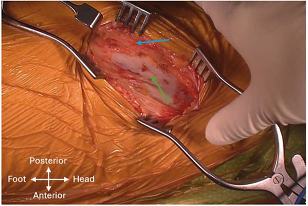 Intraoperative view of the anterolateral interval, with gluteus medius (blue arrow) posteriorly and tensor fascia lata (green arrow) anterio