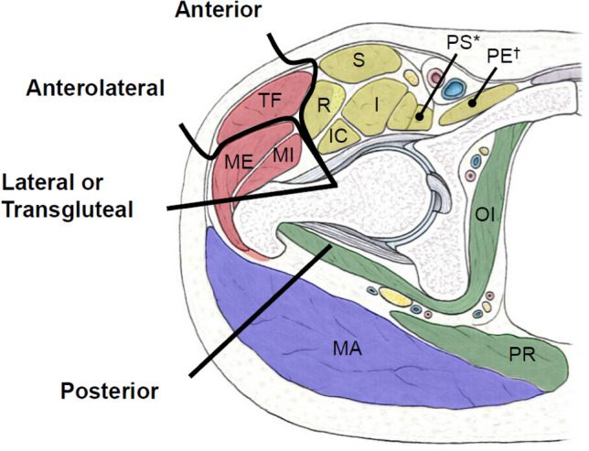 Axial diagram of the hip showing the path of each arthroplasty approach