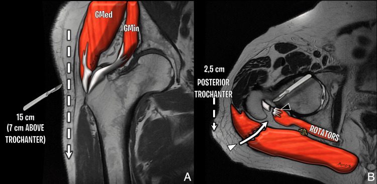 MRI based illustration of the posterior approach