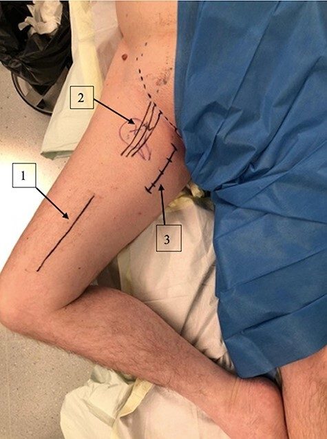 Landmarks for the medial approach with the hip in the frog leg position