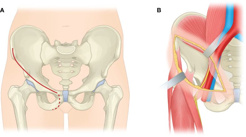 Ilioinguinal incision along the iliac crest and above the inguinal ligament towards the symphysis, with the deep exposure of the inner table