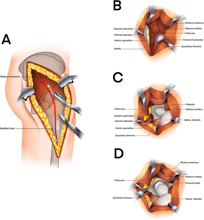 Kocher-Langenbeck approach showing the skin incision and split of gluteus maximus in line with its fibres, release of the short external rot