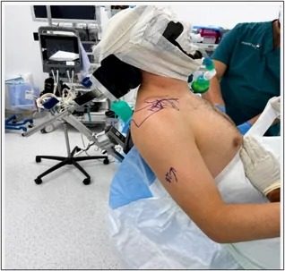 Patient seated in the beach chair position for right shoulder surgery, with the head supported and the arm resting at the side