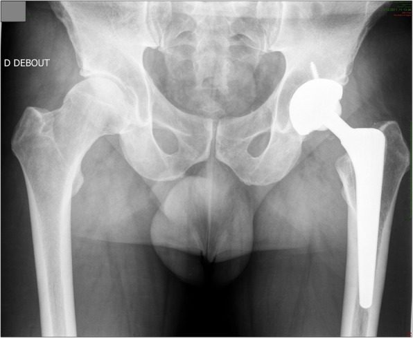 AP pelvis radiograph of a ceramic on ceramic total hip replacement
