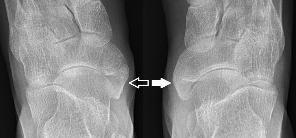 Accessory Navicular, dorsoplantar radiograph showing an accessory navicular and a cornuate navicular