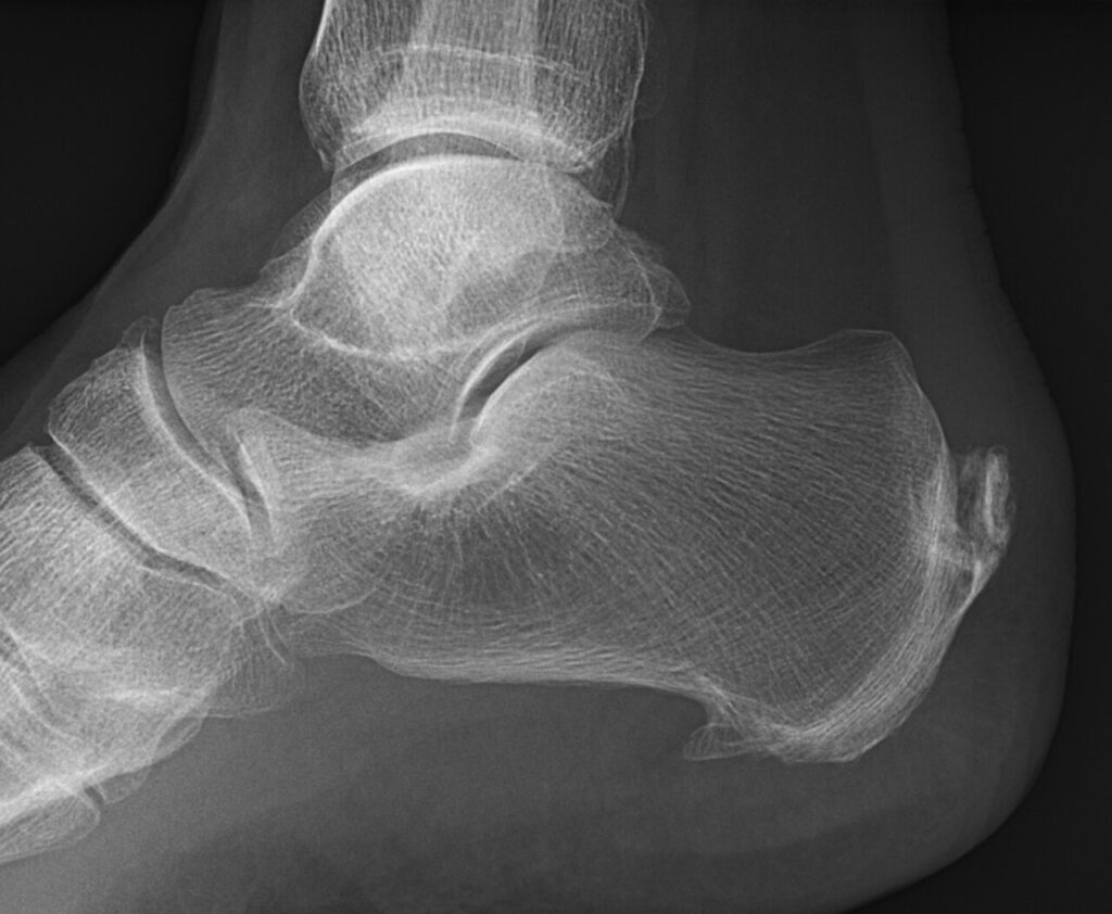 Achilles Tendinitis, radiograph of insertional calcification of the achilles tendon