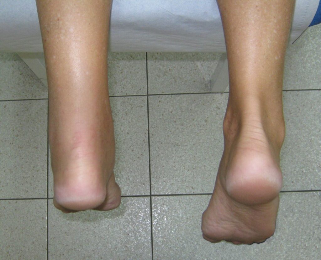 Achilles Tendon Ruptures, clinical appearance of an achilles tendon rupture