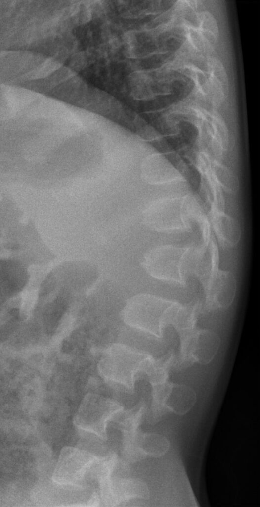 Achondroplasia Kyphosis, lateral radiograph showing deformed vertebral bodies at the thoracolumbar junction in achondroplasia