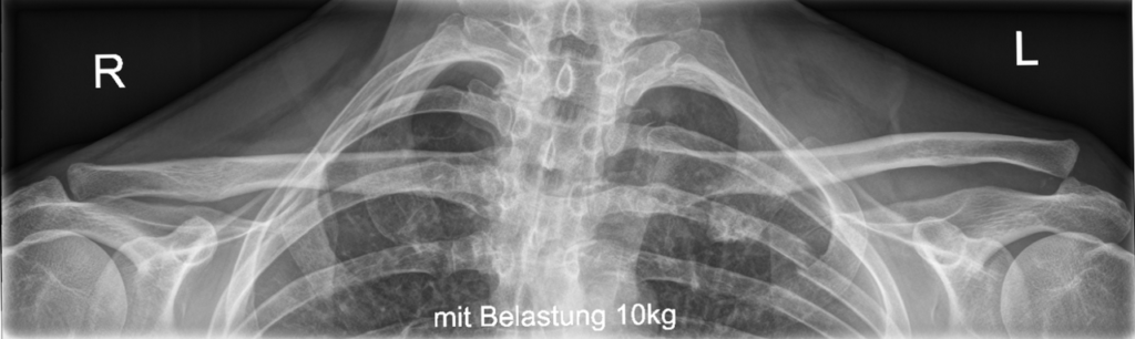 Acromioclavicular Joint Dislocation, radiograph of a rockwood type iii acromioclavicular joint dislocation