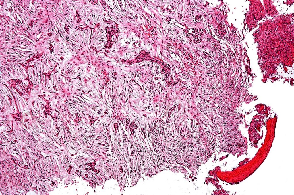 Adamantinoma, histology of adamantinoma at intermediate magnification