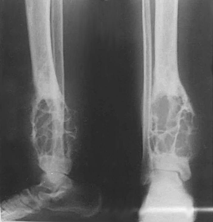 Tumour iSAWE 16, AP and lateral radiographs of the tibia