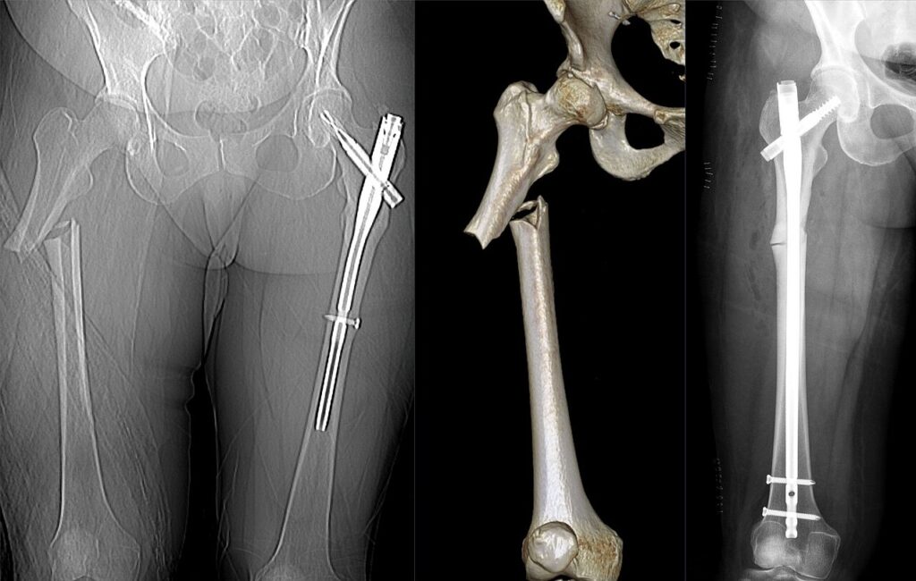 Hip iSAWE 9, imaging of the femur