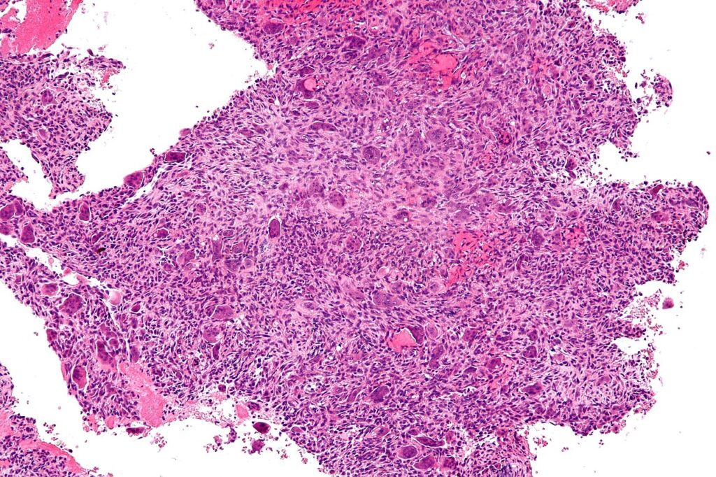 Aneurysmal Bone Cyst, histology of an aneurysmal bone cyst at intermediate magnification