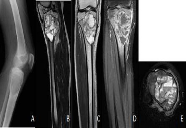Tumour iSAWE 9, radiograph and mri