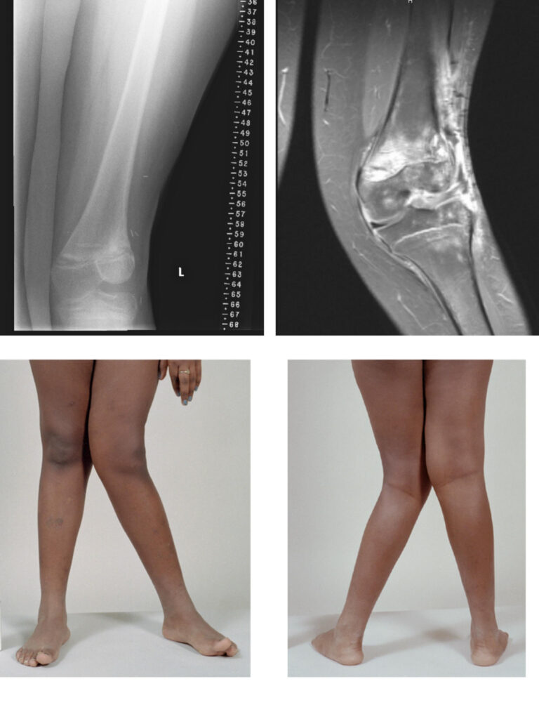 Angular Deformity of the Lower Limb, genu valgum, clinical and radiographic appearance