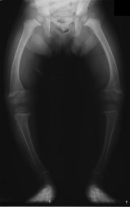 Paeds Elective iSAWE 16, radiograph of both lower limbs