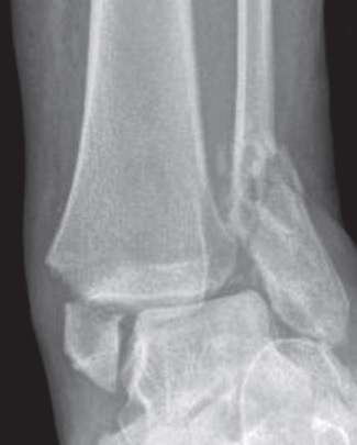 Ankle Fractures, radiograph of a bimalleolar ankle fracture