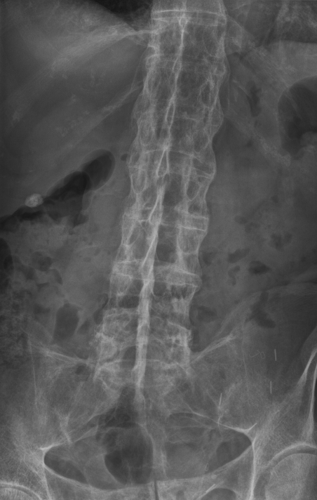 Ankylosing Spondylitis, radiograph showing bamboo spine in ankylosing spondylitis