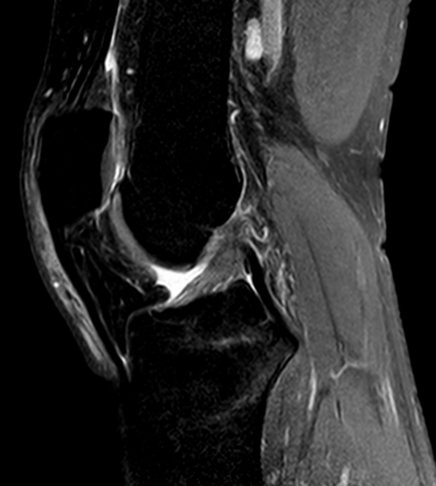 Anterior Cruciate Ligament Rupture | ACL, mri of an anterior cruciate ligament tear