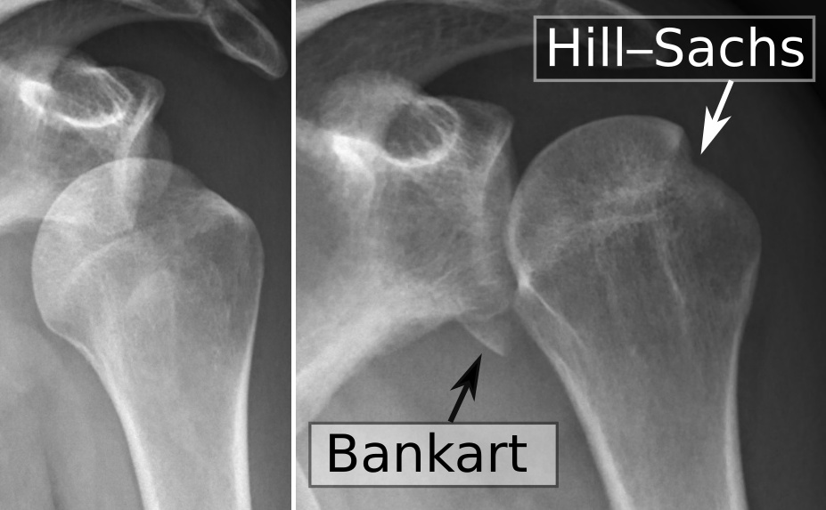 Anterior Shoulder Stabilisation, radiograph of a shoulder dislocation with bankart and hill-sachs lesions