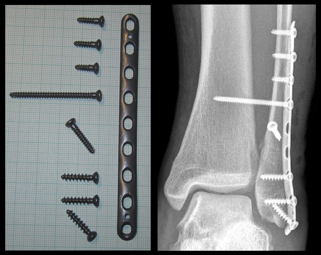 Approach to the Lateral Malleolus, radiograph of ankle fracture fixation with a lateral plate