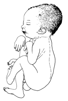 Arthrogryposis, historical drawing of arthrogryposis multiplex congenita