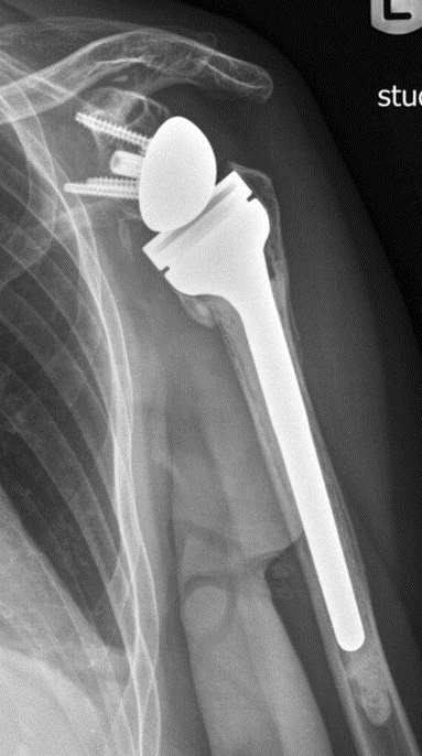 Arthroplasty iSAWE 6, AP radiograph of the shoulder