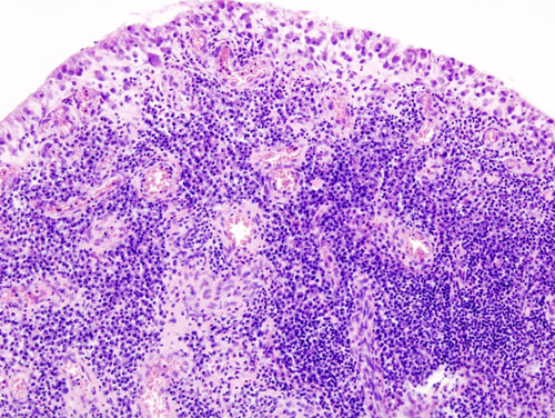 Arthroplasty iSAWE 1, synovial histology in rheumatoid arthritis (h and e)