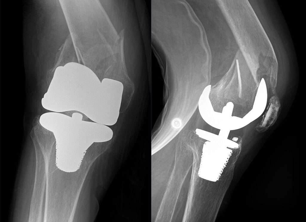 Arthroplasty iSAWE 12, AP and lateral radiographs of the knee
