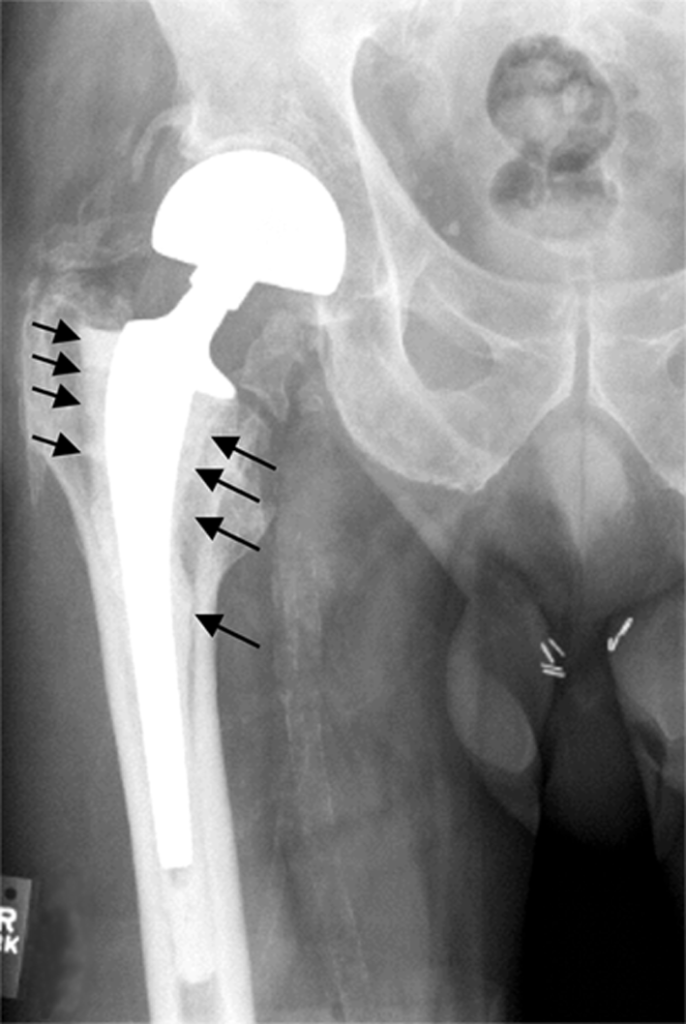 Arthroplasty iSAWE 13, AP radiograph of a total hip arthroplasty