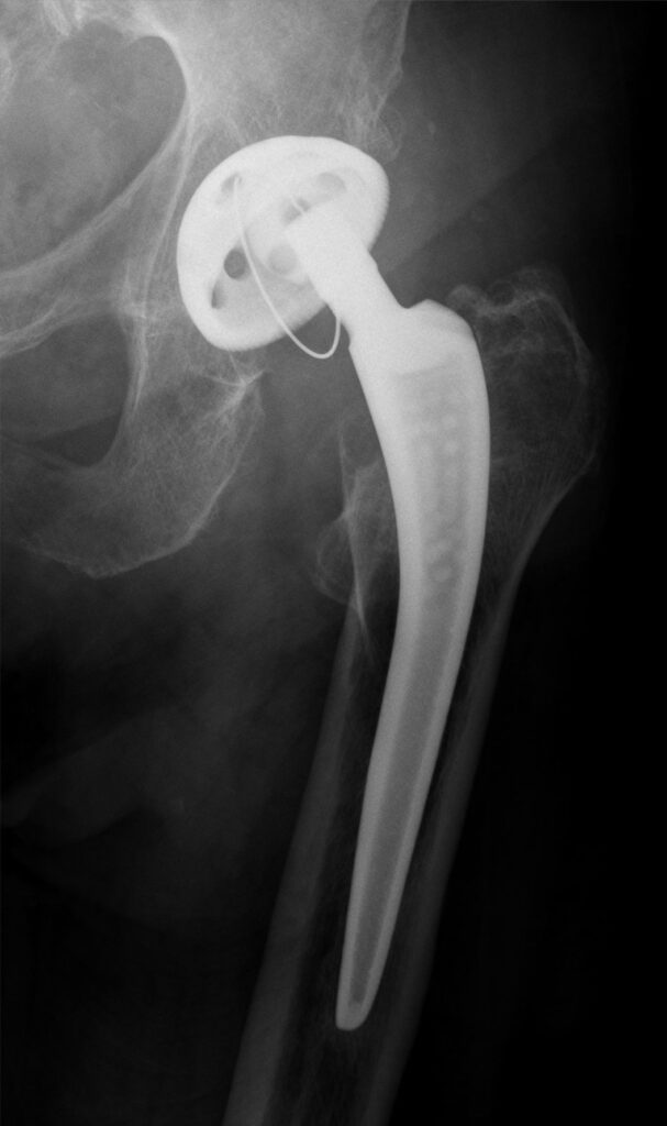 Arthroplasty iSAWE 14, AP radiograph of a total hip arthroplasty